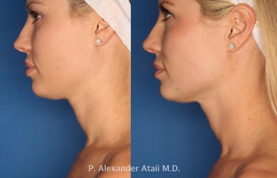 Ultherapy Gallery Before & After Gallery - Patient 24560689 - Image 2