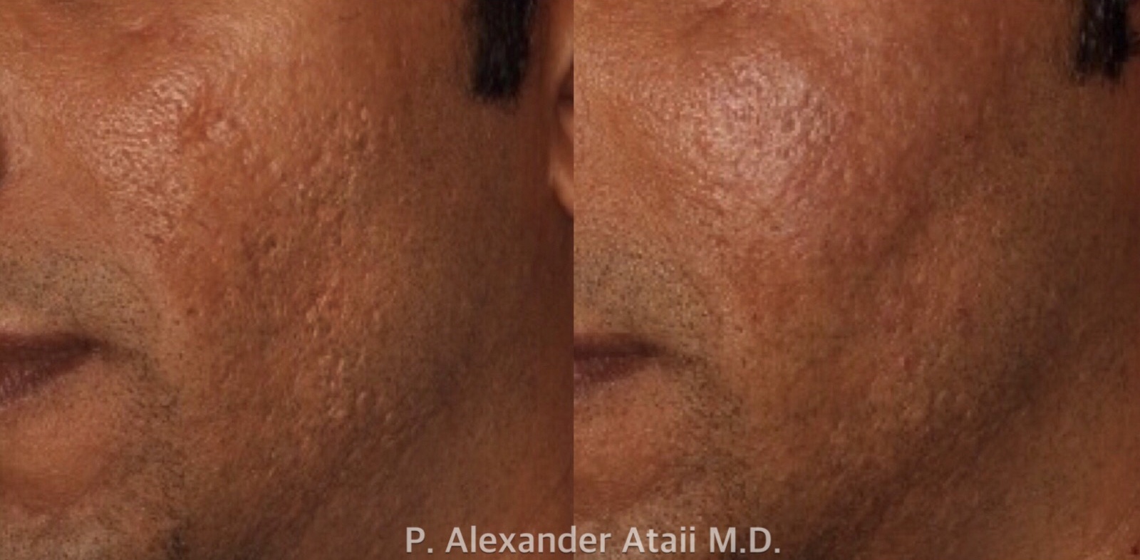 Dermal Fillers Before & After Gallery - Patient 343053 - Image 1