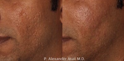 Dermal Fillers Before & After Gallery - Patient 343053 - Image 1