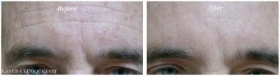 BOTOX Before & After Gallery - Patient 24560691 - Image 1
