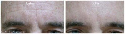 Botox/ Dysport/ Xeomin Gallery Before & After Gallery - Patient 24560691 - Image 1