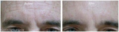 Botox/ Dysport/ Xeomin Gallery Before & After Gallery - Patient 24560691 - Image 1