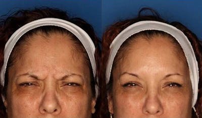 BOTOX Before & After Gallery - Patient 24560699 - Image 1