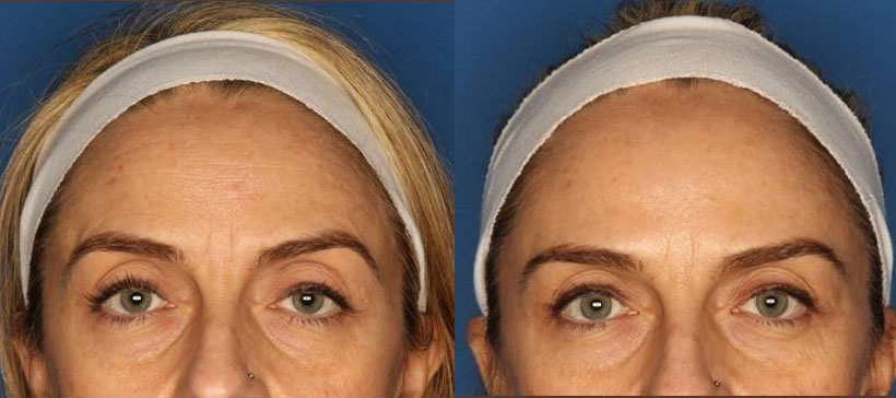 Botox/ Dysport/ Xeomin Before & After Gallery - Patient 24560702 - Image 1