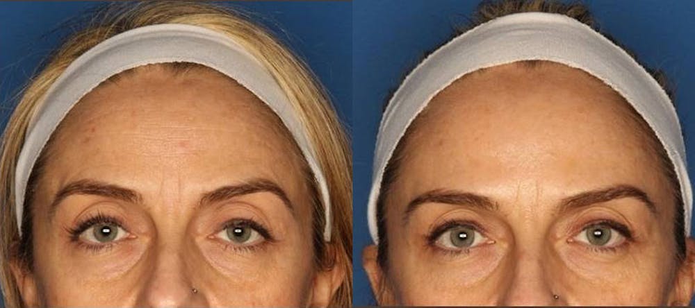 Before and After Botox in La Jolla