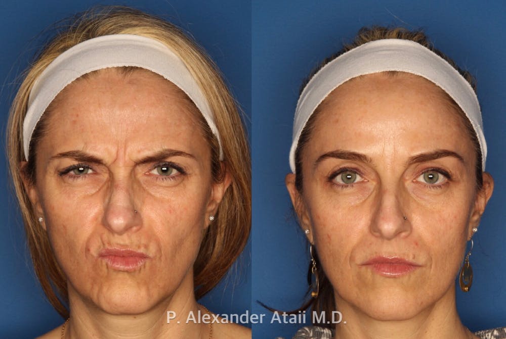 BOTOX Before & After Gallery - Patient 24560702 - Image 2