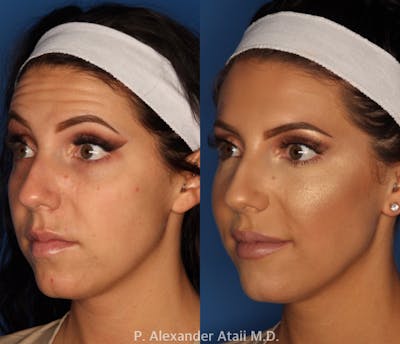 Botox/ Dysport/ Xeomin Gallery Before & After Gallery - Patient 24560738 - Image 1