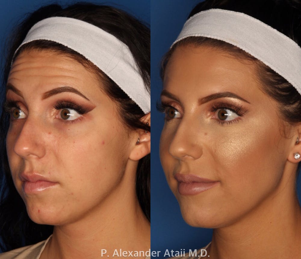 BOTOX Before & After Gallery - Patient 24560738 - Image 1