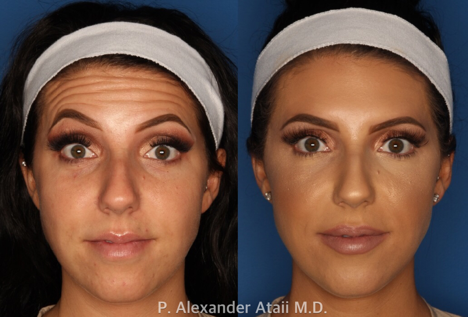 Botox/ Dysport/ Xeomin Gallery Before & After Gallery - Patient 24560738 - Image 2