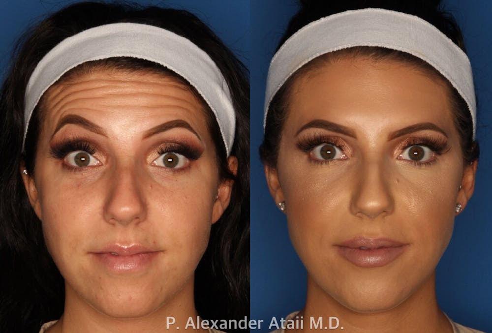 BOTOX Before & After Gallery - Patient 24560738 - Image 2