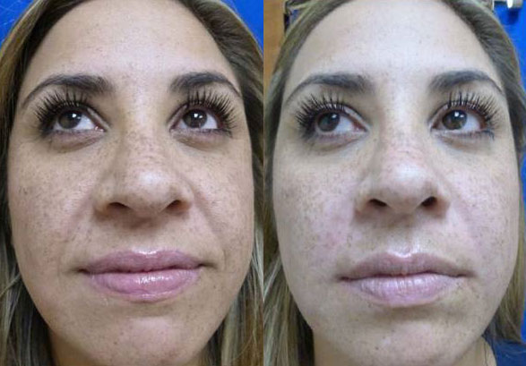 Juvederm Ultra XC Before & After Gallery - Patient 24560732 - Image 1