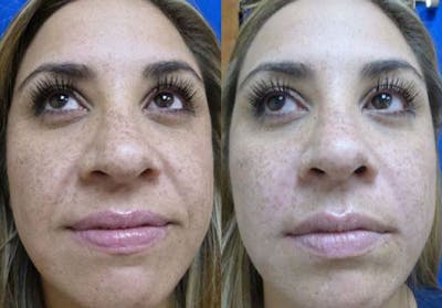 Juvederm Ultra XC Gallery - Patient 24560732 - Image 1