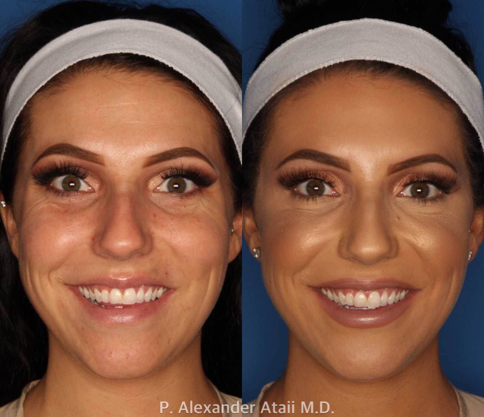 Botox/ Dysport/ Xeomin Before & After Gallery - Patient 24560738 - Image 3