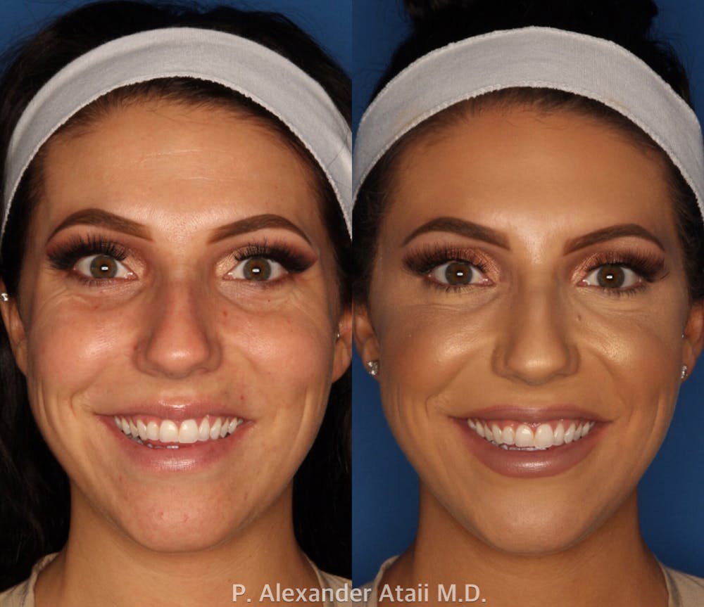 BOTOX Before & After Gallery - Patient 24560738 - Image 3