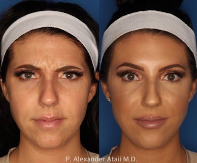 Botox/ Dysport/ Xeomin Before & After Gallery - Patient 24560738 - Image 4