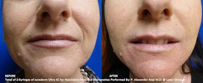 Dermal Fillers Gallery Before & After Gallery - Patient 188462 - Image 1