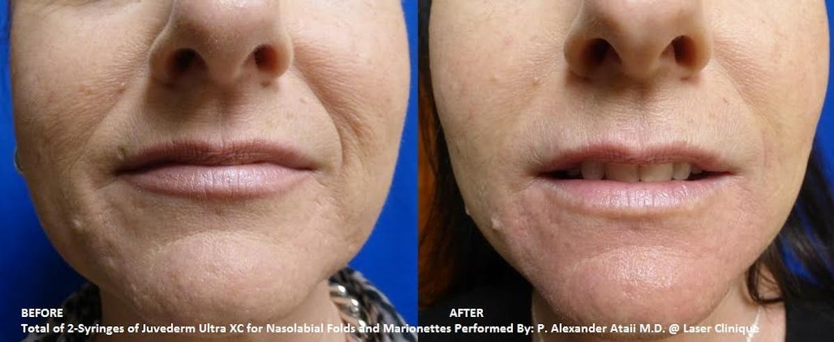 Juvederm Ultra XC Before & After Gallery - Patient 24560737 - Image 1
