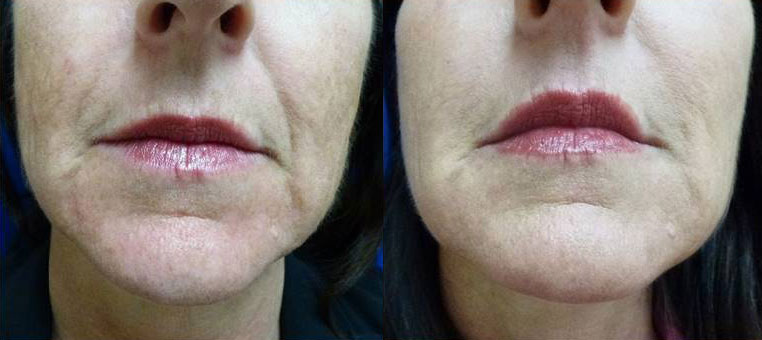 Dermal Fillers Gallery Before & After Gallery - Patient 168327 - Image 1