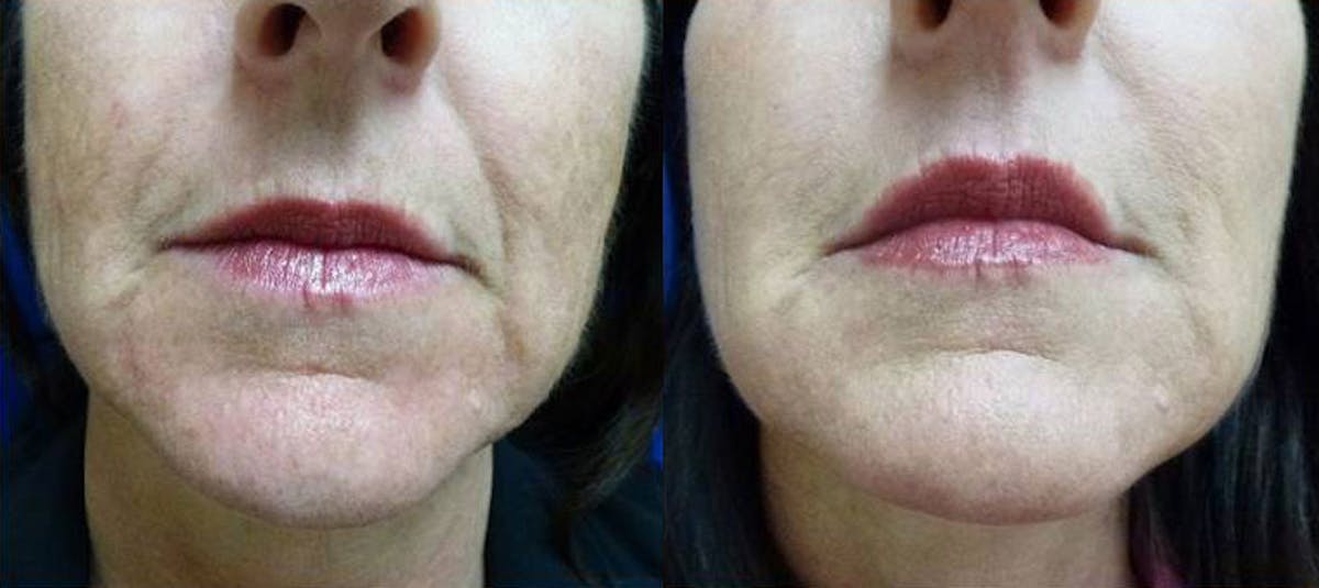 Dermal Fillers Gallery Before & After Gallery - Patient 168327 - Image 1