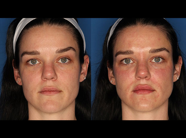 Juvederm Ultra XC Before & After Gallery - Patient 24560779 - Image 1
