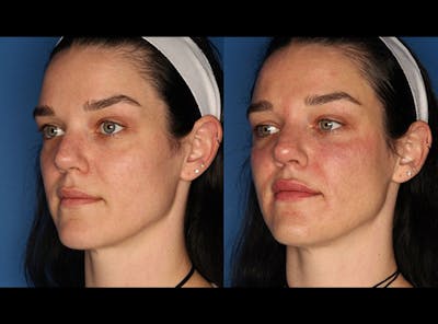 Dermal Fillers Before & After Gallery - Patient 327074 - Image 2