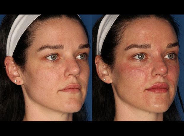 Dermal Fillers Gallery Before & After Gallery - Patient 327074 - Image 3