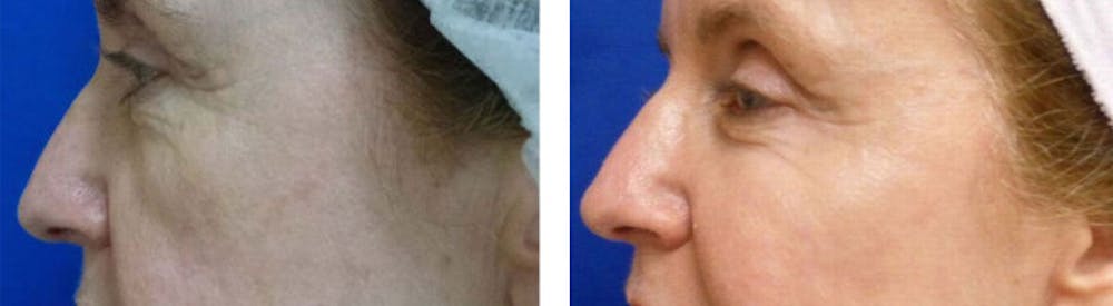 Juvederm Voluma Before & After Gallery - Patient 24560780 - Image 1