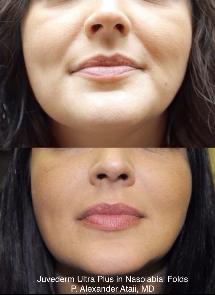 Dermal Fillers Before & After Gallery - Patient 805861 - Image 1
