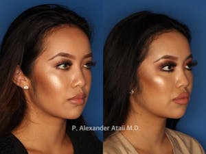 Before and after Juvéderm Voluma in San Diego