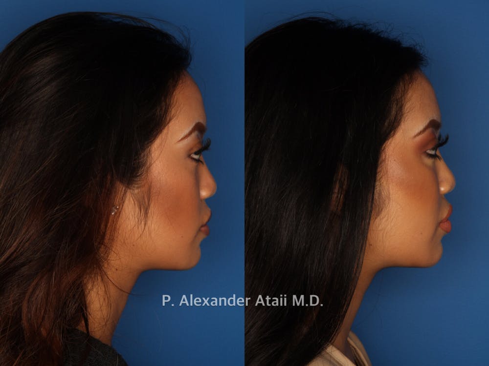 Juvederm Voluma Before & After Gallery - Patient 24560784 - Image 2