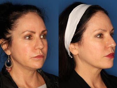 Kybella Before & After Gallery - Patient 24560792 - Image 1