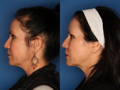 Kybella Gallery Before & After Gallery - Patient 24560792 - Image 2