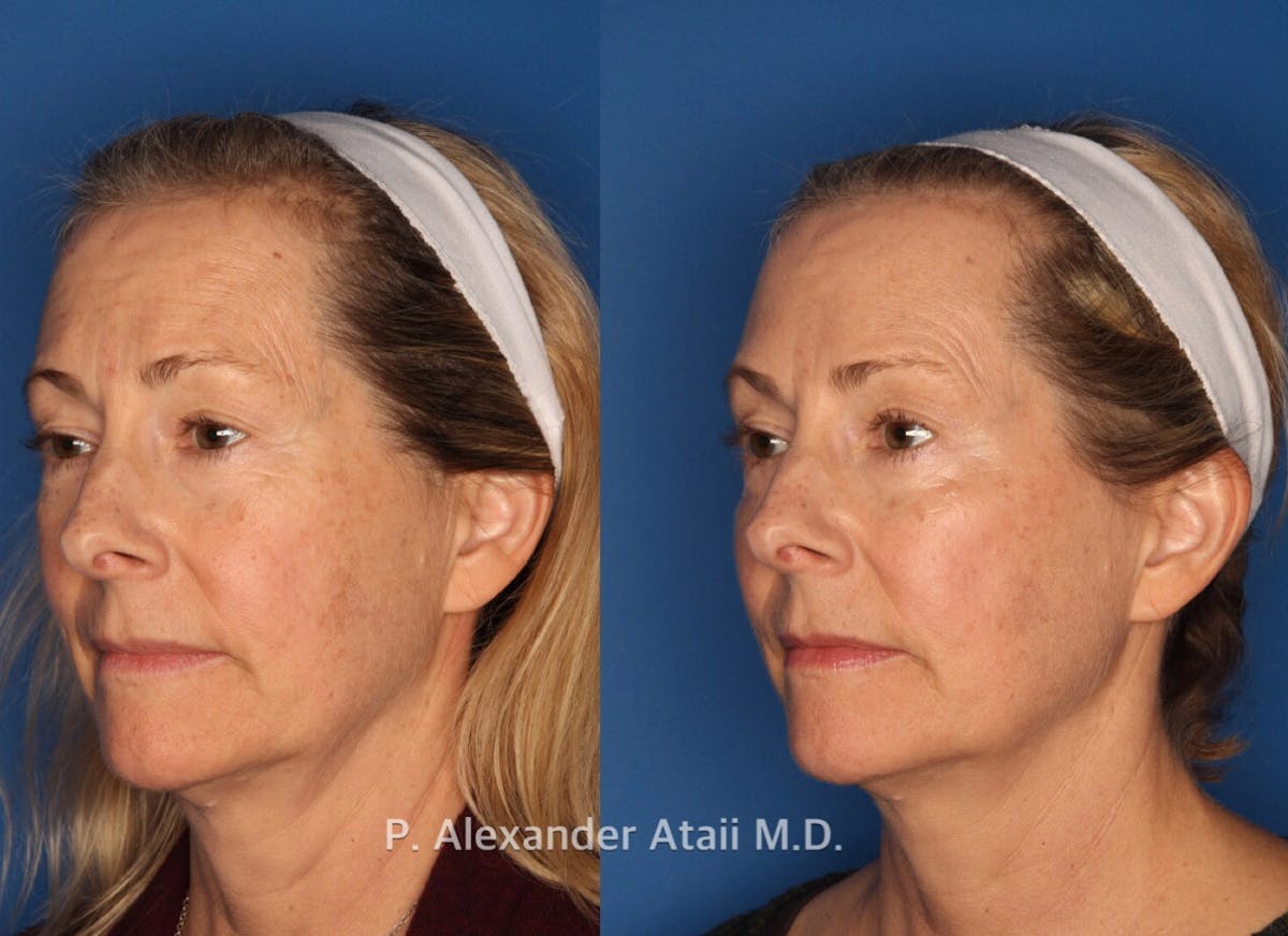 Dermal Fillers Gallery Before & After Gallery - Patient 350267 - Image 1
