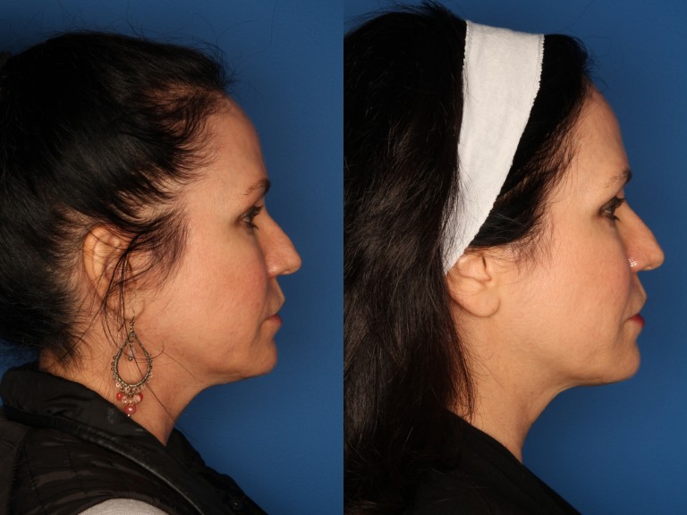 Kybella Gallery Before & After Gallery - Patient 24560792 - Image 3