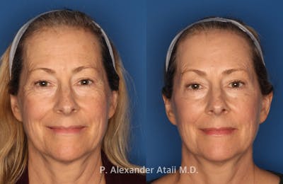 Dermal Fillers Gallery Before & After Gallery - Patient 350267 - Image 2