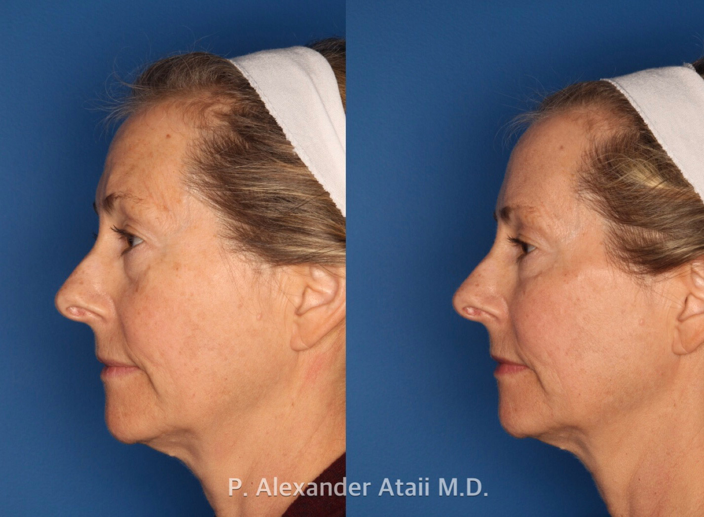 Dermal Fillers Gallery Before & After Gallery - Patient 350267 - Image 3