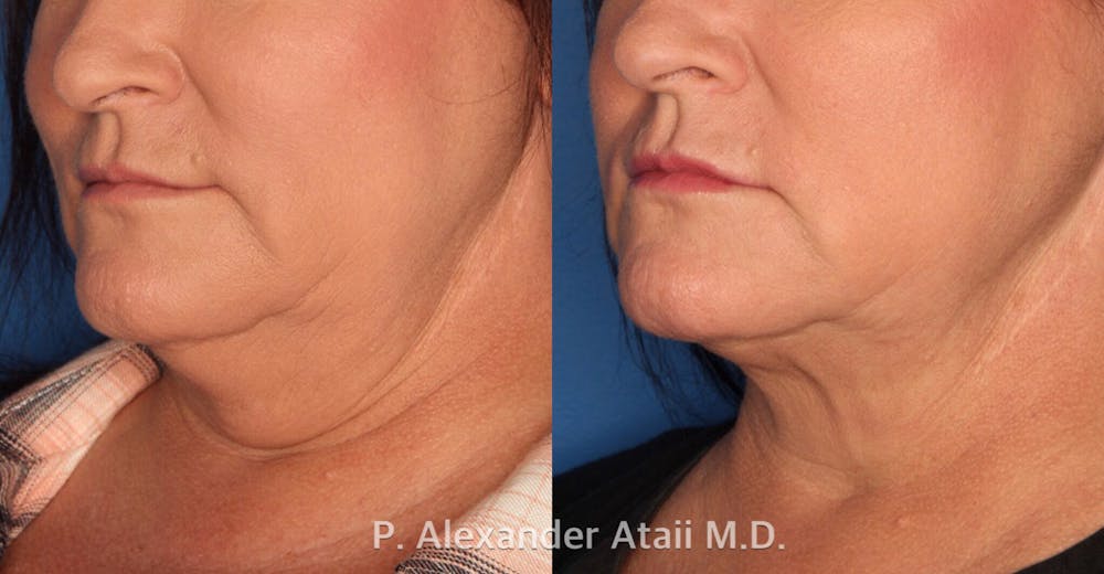 Kybella in La Jolla.