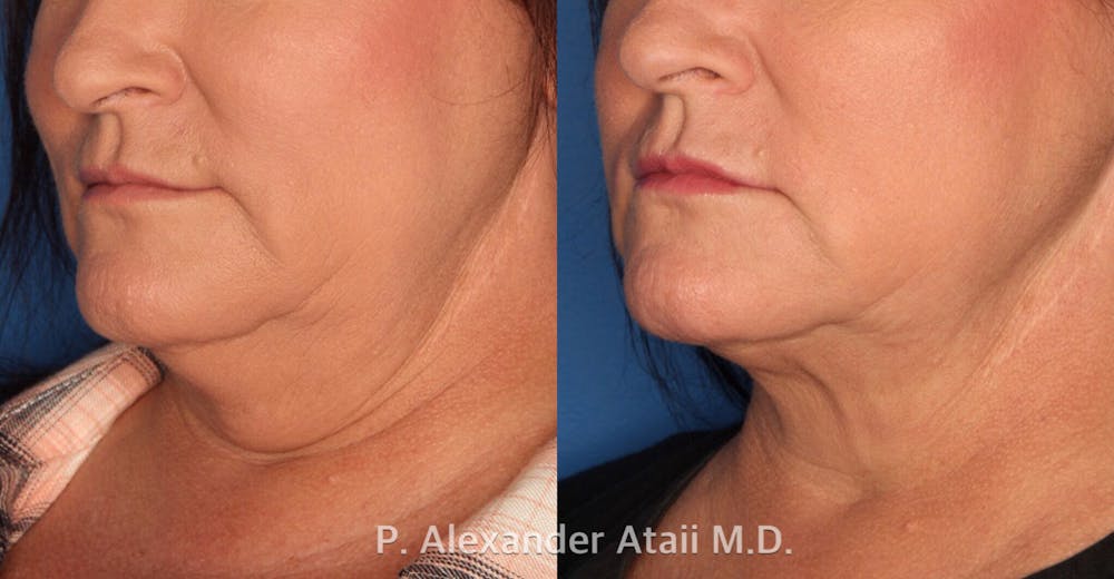 Kybella Before & After Gallery - Patient 24560802 - Image 1