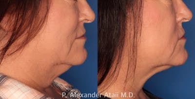 Kybella Gallery Before & After Gallery - Patient 24560802 - Image 2