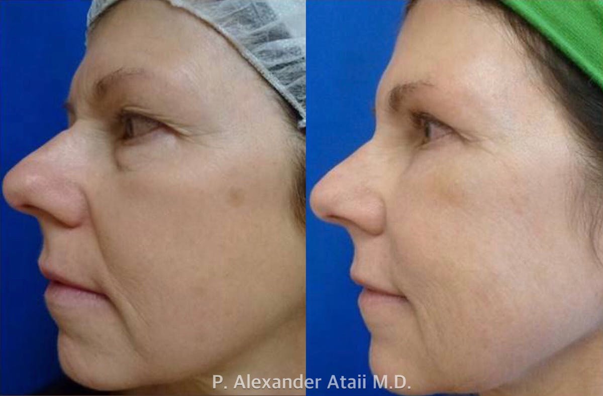 Liquid Facelift Before & After Gallery - Patient 24560803 - Image 1