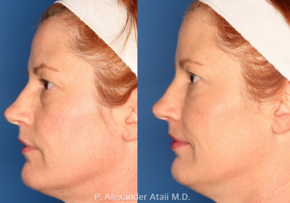 Juvederm Voluma Before & After Gallery - Patient 24560804 - Image 1