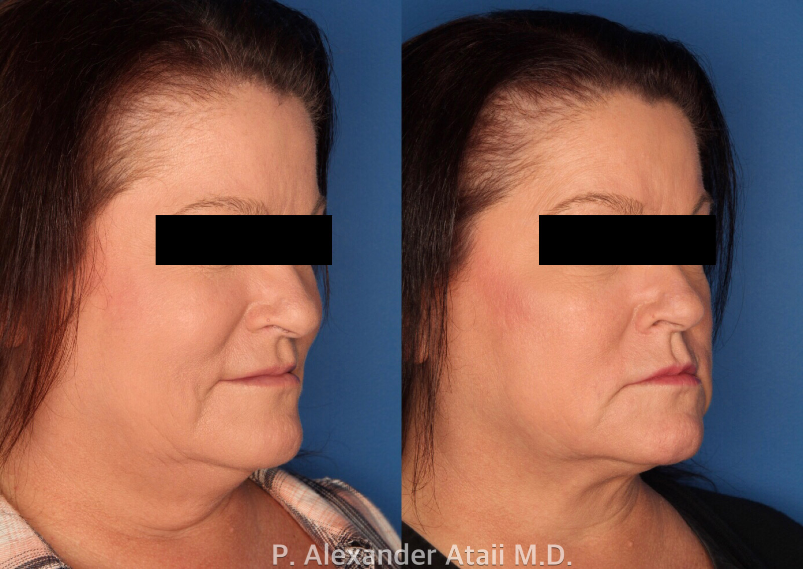 Kybella Gallery Before & After Gallery - Patient 24560802 - Image 3