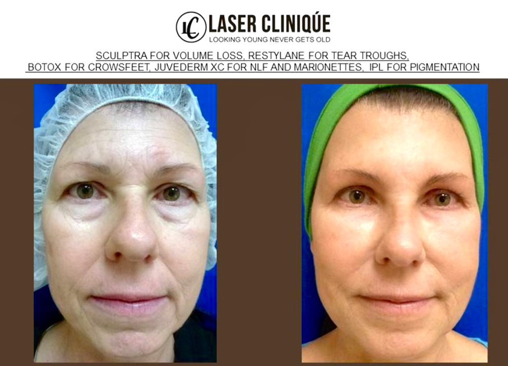 Liquid Facelift Before & After Gallery - Patient 24560803 - Image 2
