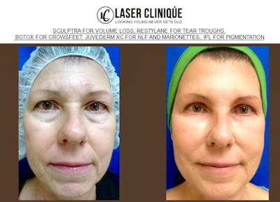 Liquid Facelift Gallery Before & After Gallery - Patient 24560803 - Image 2