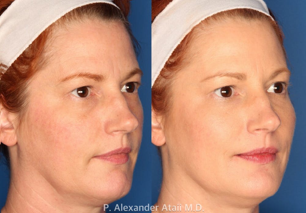 Juvederm Voluma Before & After Gallery - Patient 24560804 - Image 2