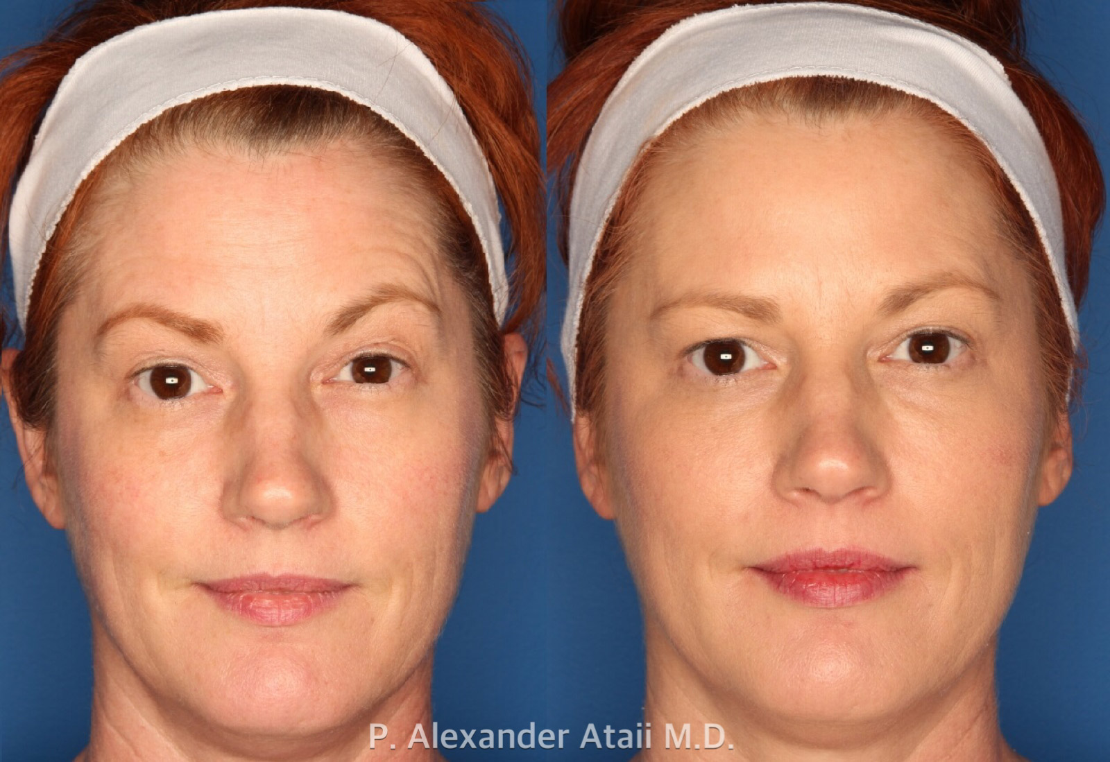 Dermal Fillers Gallery Before & After Gallery - Patient 224719 - Image 3