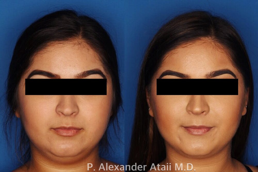 Kybella in San Diego.