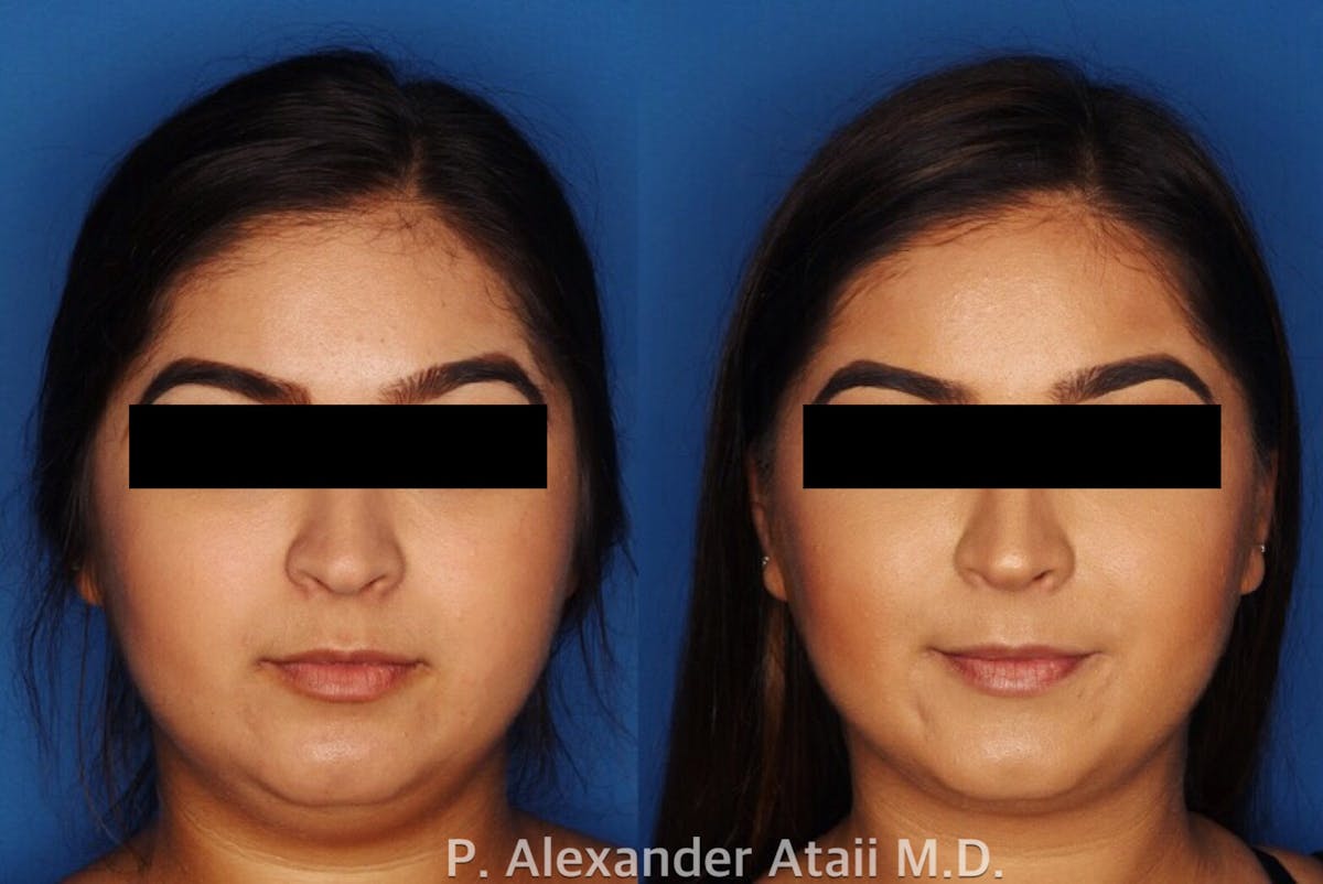 Kybella Gallery Before & After Gallery - Patient 24560814 - Image 1