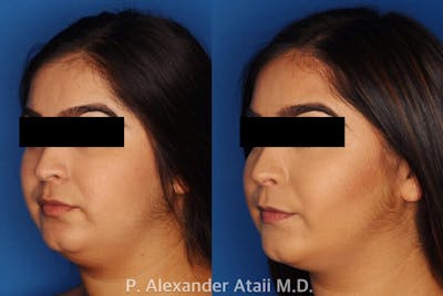 Kybella Gallery Before & After Gallery - Patient 24560814 - Image 2