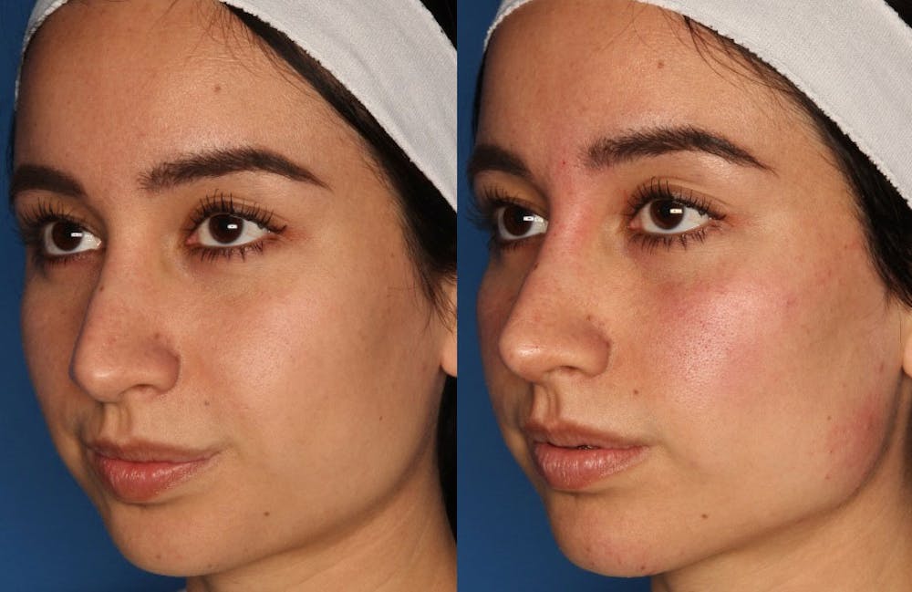 Juvederm Voluma Before & After Gallery - Patient 24560817 - Image 1